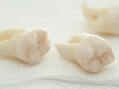 智齒疼了，這牙非拔不可嗎？