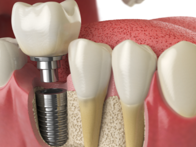 選擇種植牙后要做哪些日常維護？
