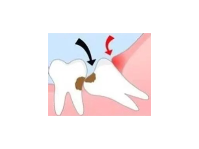 吃完飯后老塞牙？別大意！這可能是你的牙齒在報(bào)警