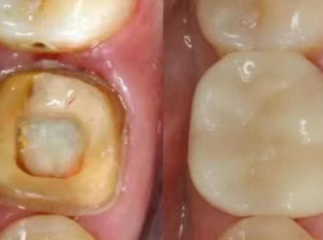 根管治療（抽神經(jīng)）后，為什么一定要做牙冠？