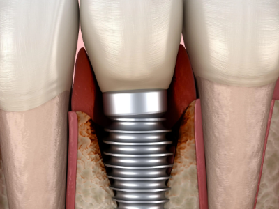 種植牙的術(shù)前準(zhǔn)備有哪些？