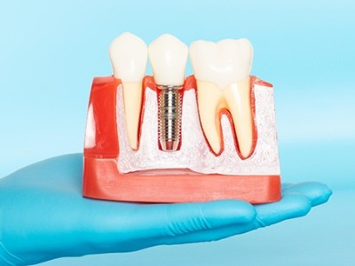 種牙VS鑲牙，你適合哪種?