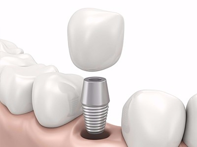 在承德哪家口腔醫(yī)院口腔種植齒好一點，惟德口腔醫(yī)院值得您的選擇