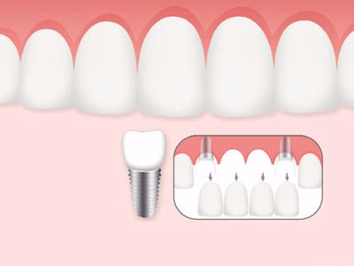 惟德口腔口腔種植怎么樣？惟德口腔就來為您一一解答