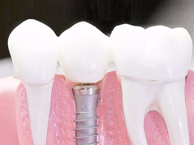 在承德口腔種植齒需要多少錢？惟德口腔一一為您道來