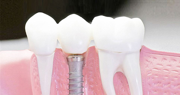 在承德口腔種植牙齒需要多少錢？惟德口腔一一為您道來