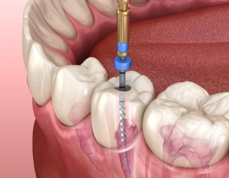 根管治療后的注意事項(xiàng)有哪些？