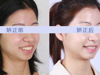 牙齒矯正與正畸的區(qū)別及治療護理要點