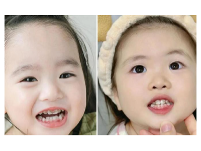 河北惟德口腔涂氟太貼心，孩子不抗拒，家長更省心